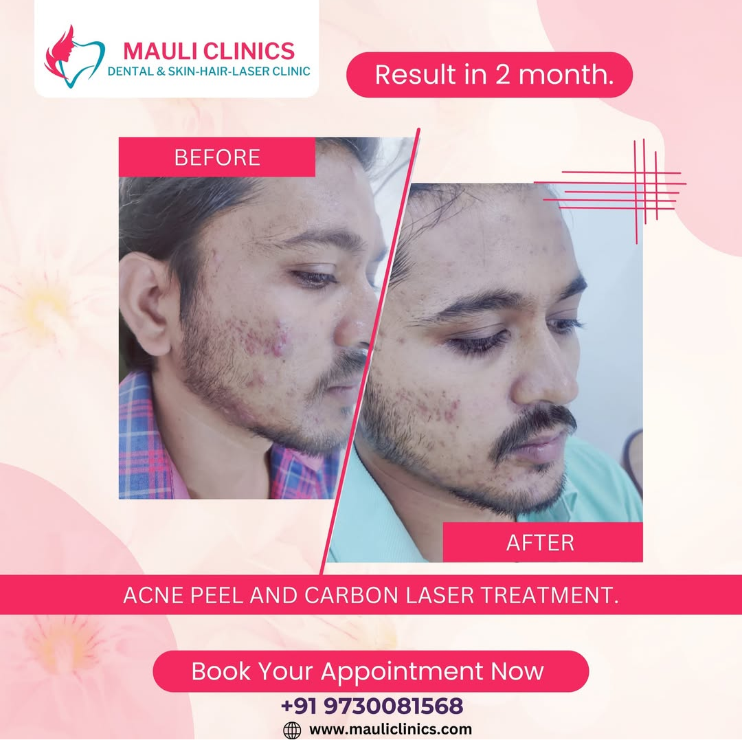 Acne peel Treatment in Nashik : we offer Imported ... main image