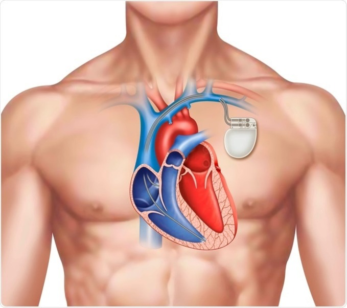 PACEMAKER :

A pacemaker is a small medical dev... main image