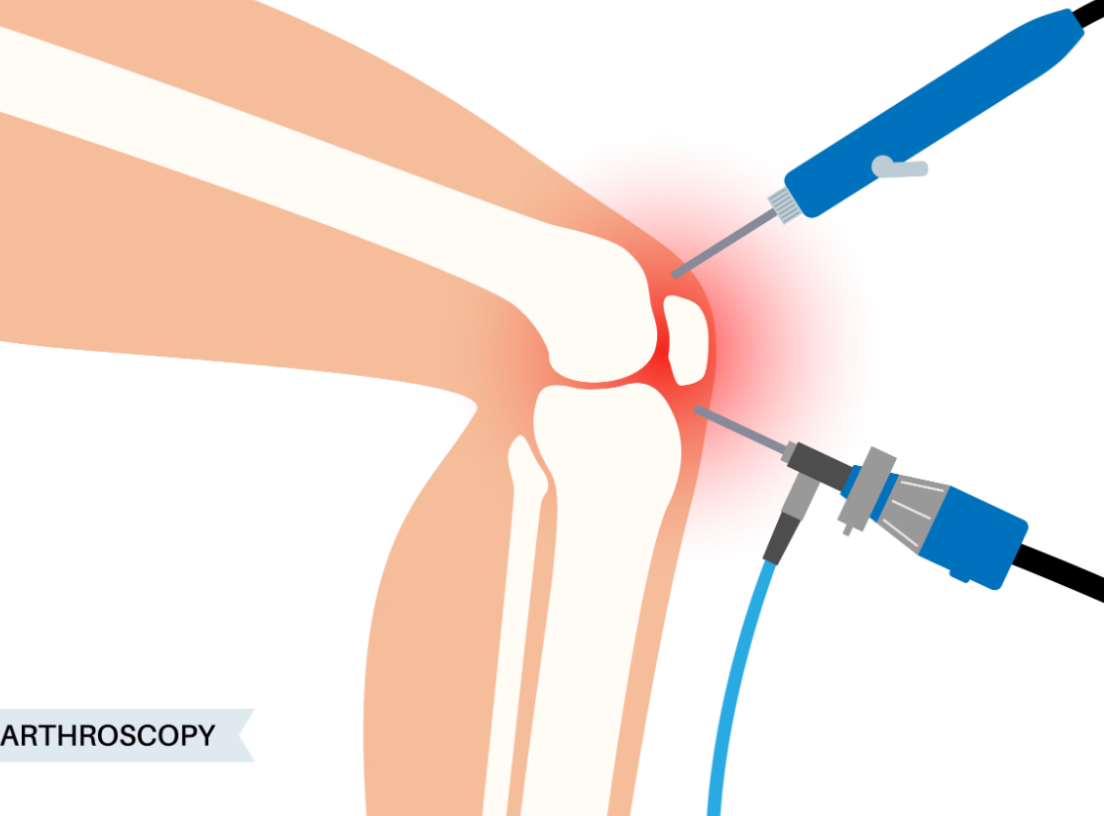 Best Arthroscopy Procedures in Chennai at KC Hospi... main image