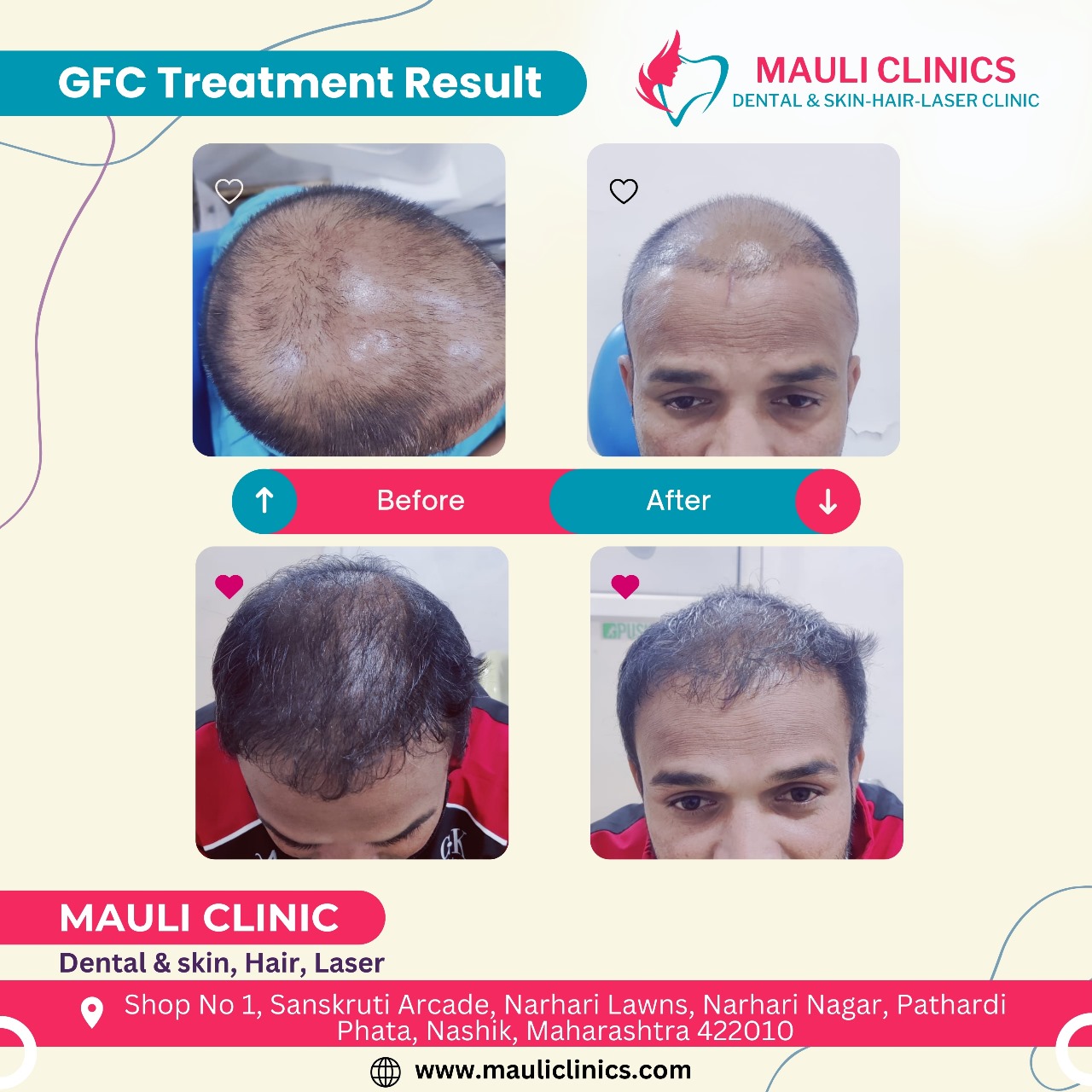 Best GFC Treatment in Nasik : we offer Best and Af... main image