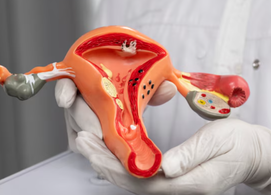 Fibroid Removal in Lohegaon Pune: Advanced Surg... main image