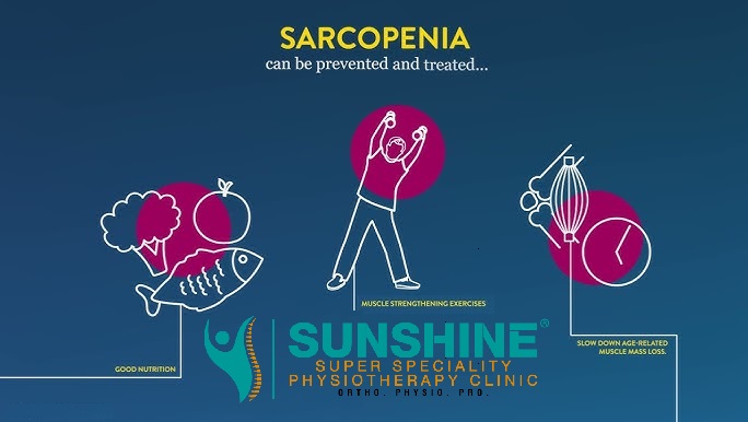Understanding Sarcopenia Sarcopenia is the progres... main image