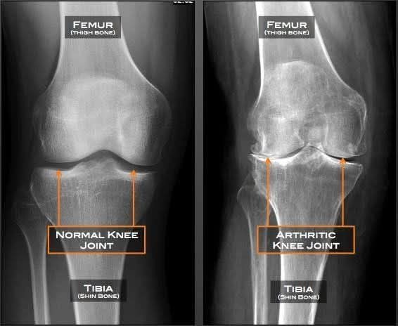Knee Osteoarthritis Assessment & Treatment - Onlin... main image