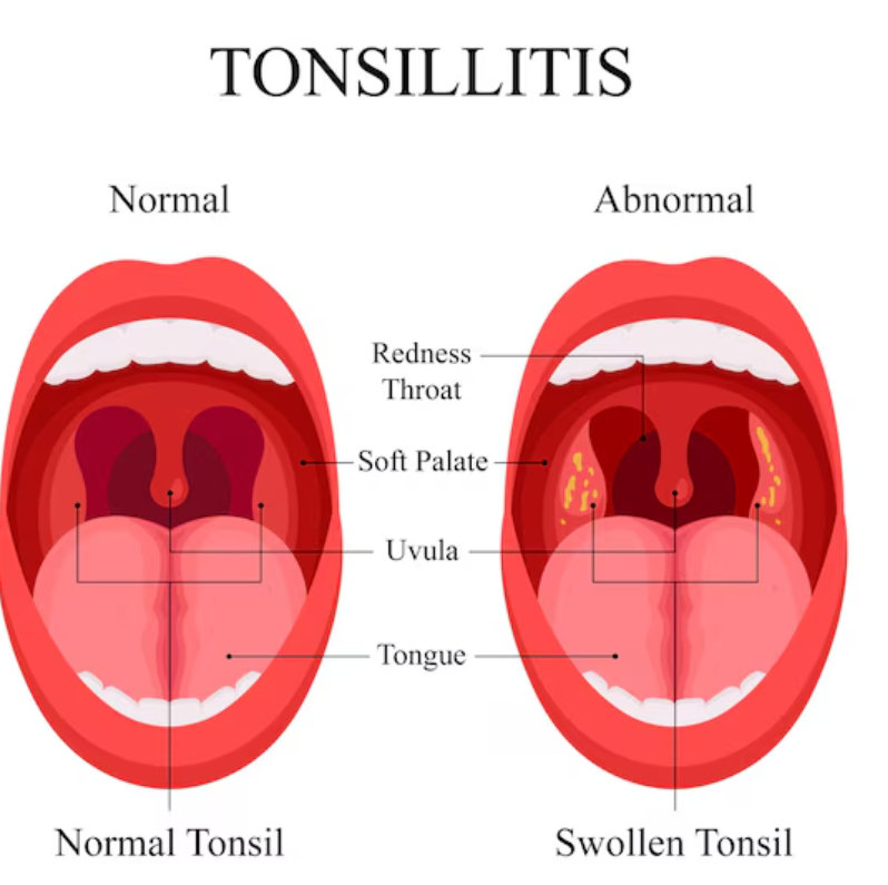 Best Tonsillitis Treatment for Kids in Jaipur Recu... main image