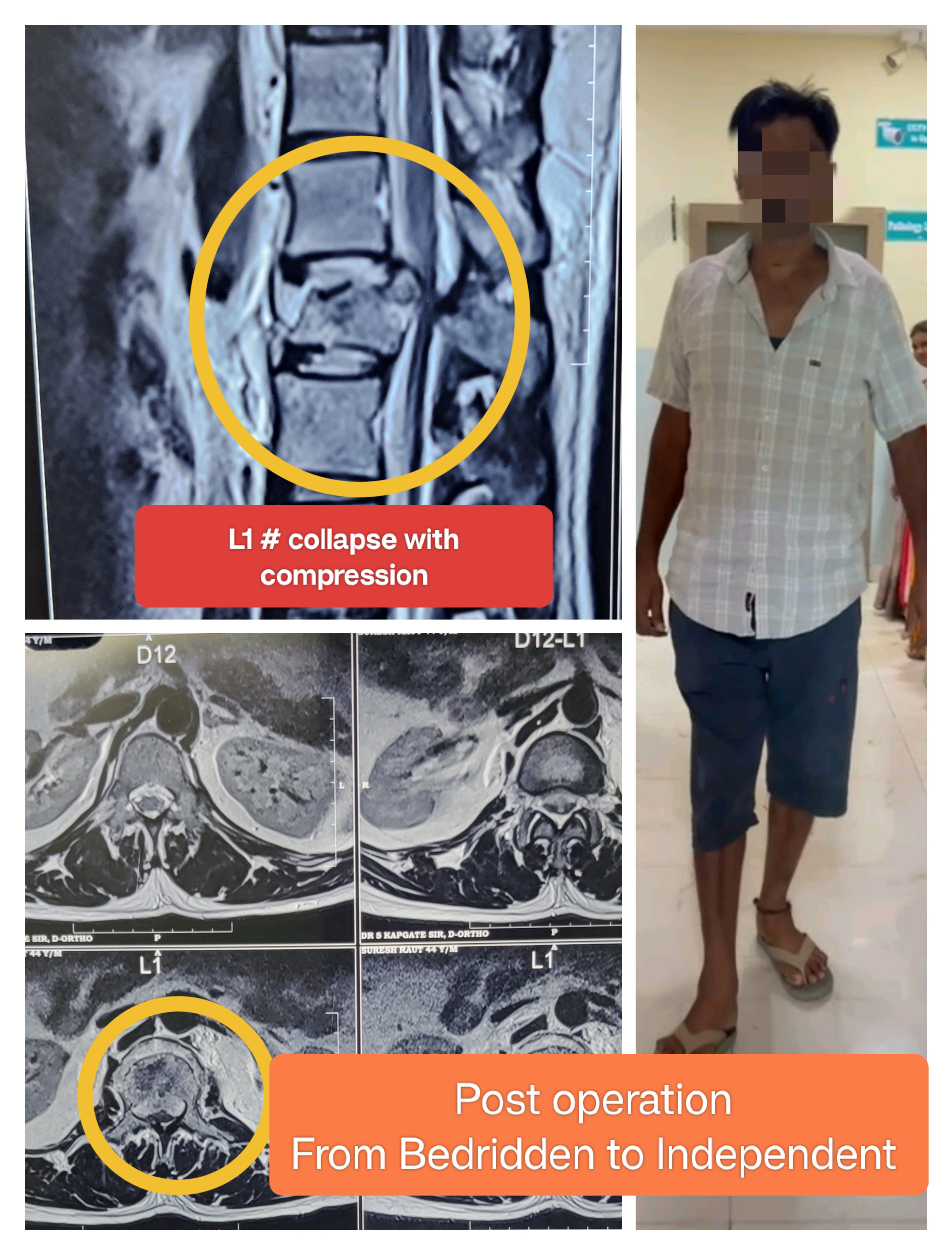 Successful Spine Surgery Restores Mobility and ... main image