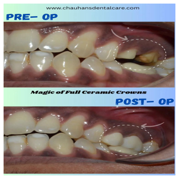 Sleek, Strong, and Stunning!
Zirconia crowns on... main image