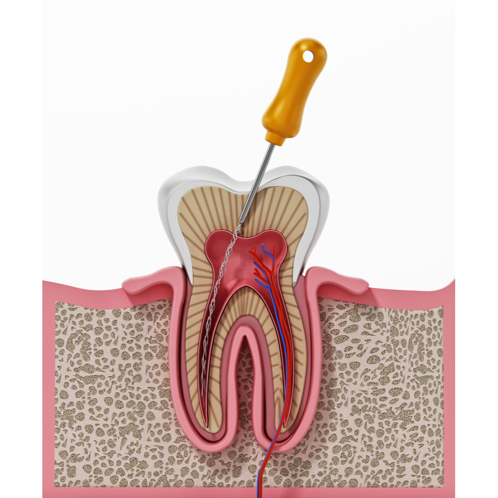 Best Root Canal Specialist in Nagpur – Pain-Fre... main image