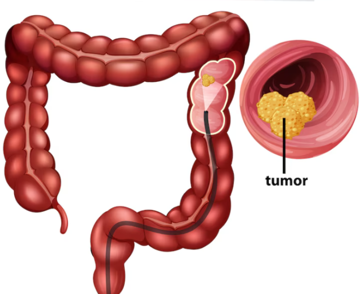 Robotic Rectal Cancer Surgery in Dasarahalli Ro... main image
