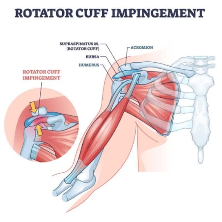 Shoulder impingement is one of the most common iss... main image