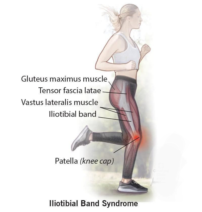 Iliotibial Band (IT Band) Syndrome IT band syndrom... main image