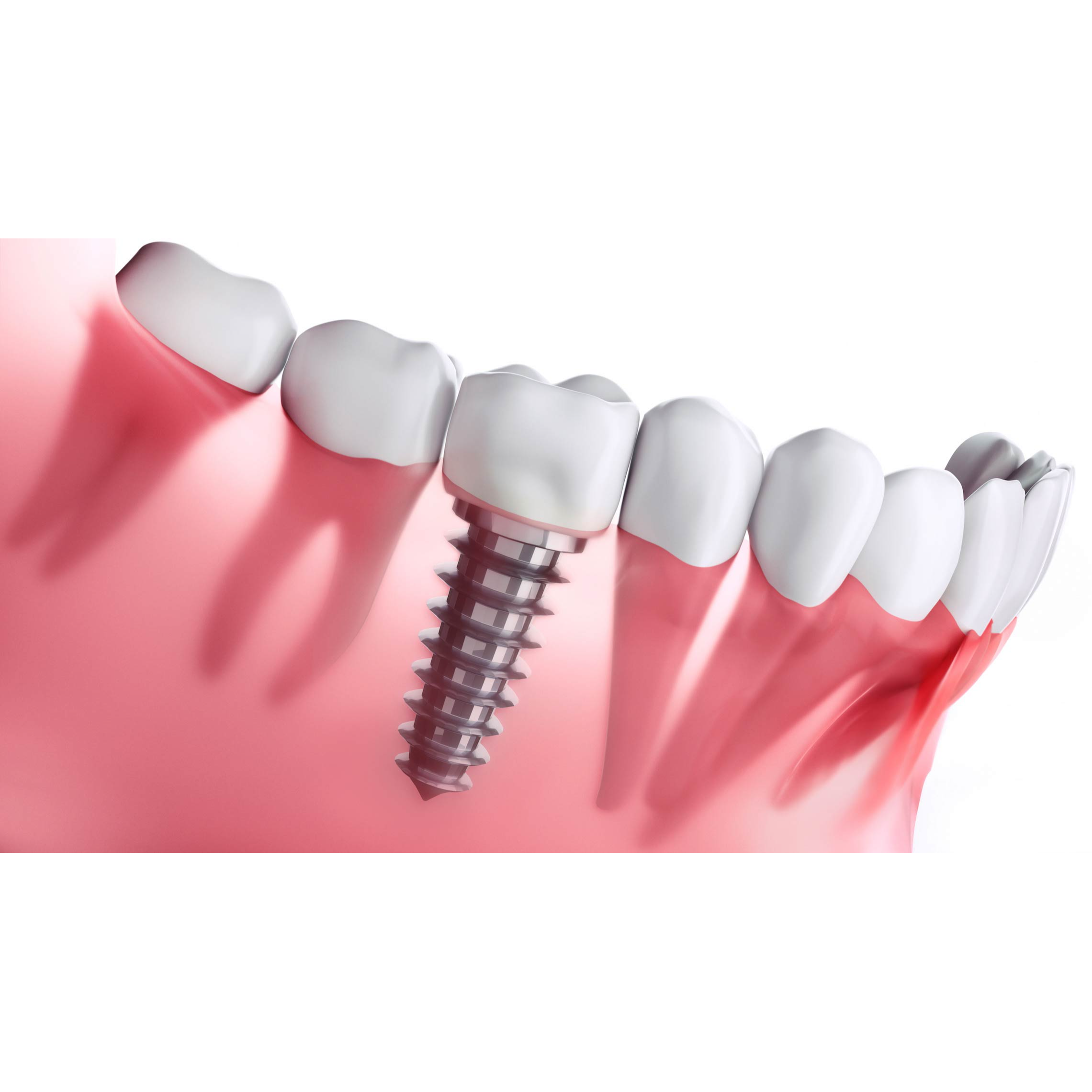 Dental Implants at Paras Dental Care – Best Den... main image