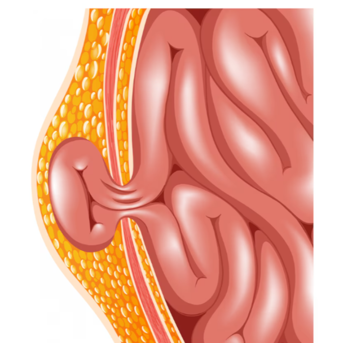 Hernia Surgery Hospital in Pimpri – Safe and Ef... main image