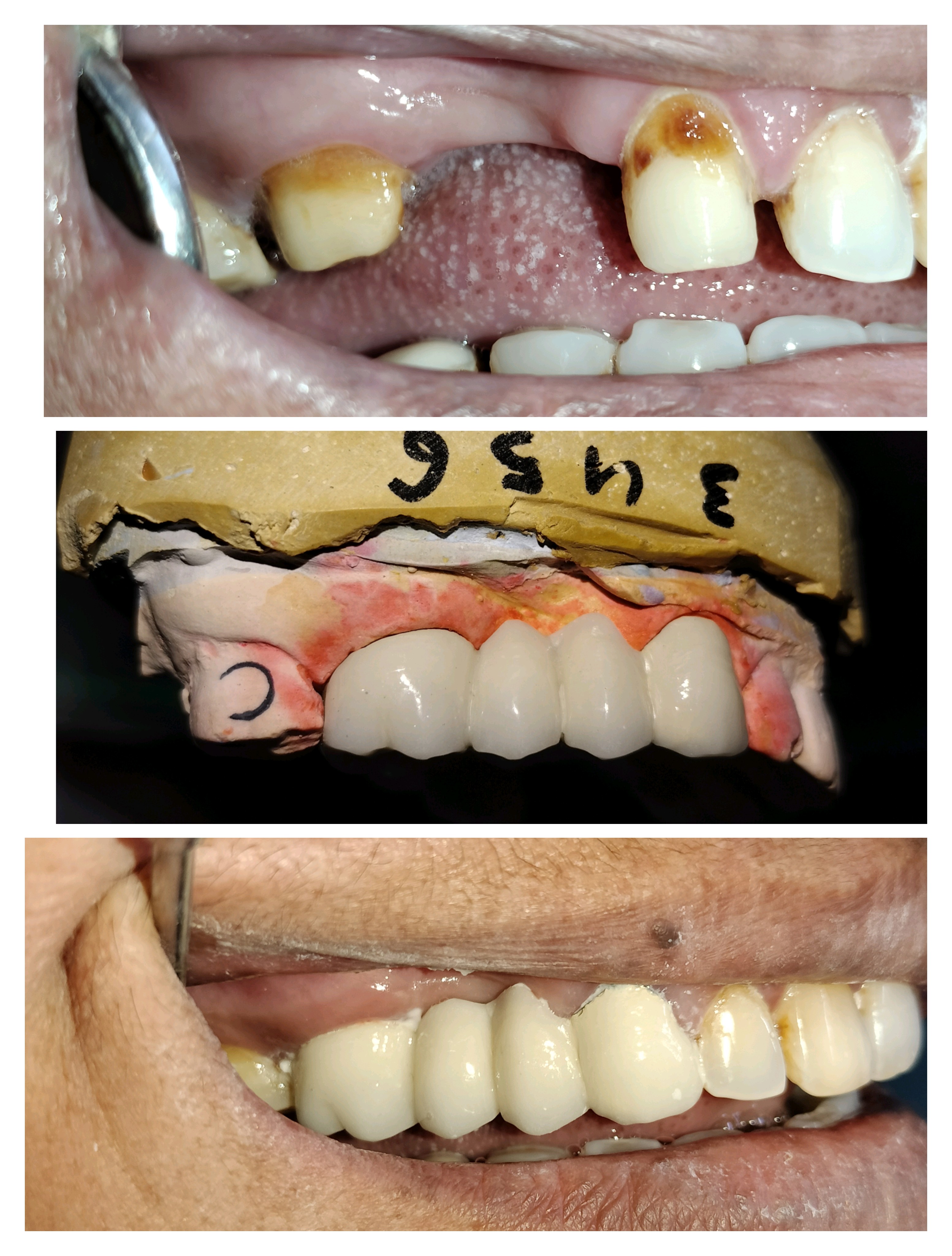 Cosmetic dentist in Mira road Dental bridge and... main image