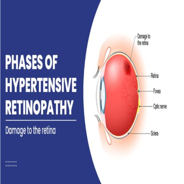 Hypertensive Retinopathy in Nagpur – Managing E... main image
