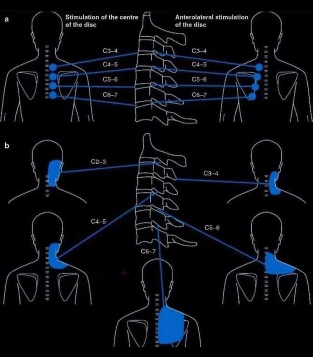 🚨🧠Areas irritated by C3, C4, C5, C6 and C7 nerves:... main image