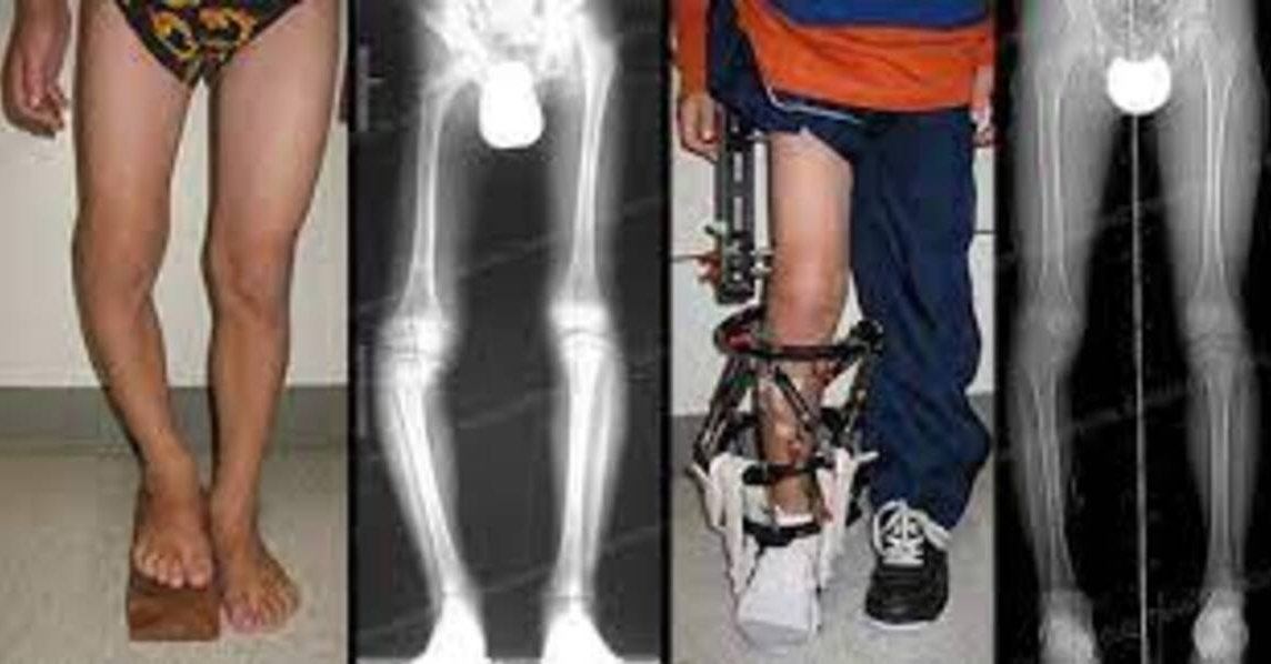 Limb Lengthening Services in Pune for Growth an... main image