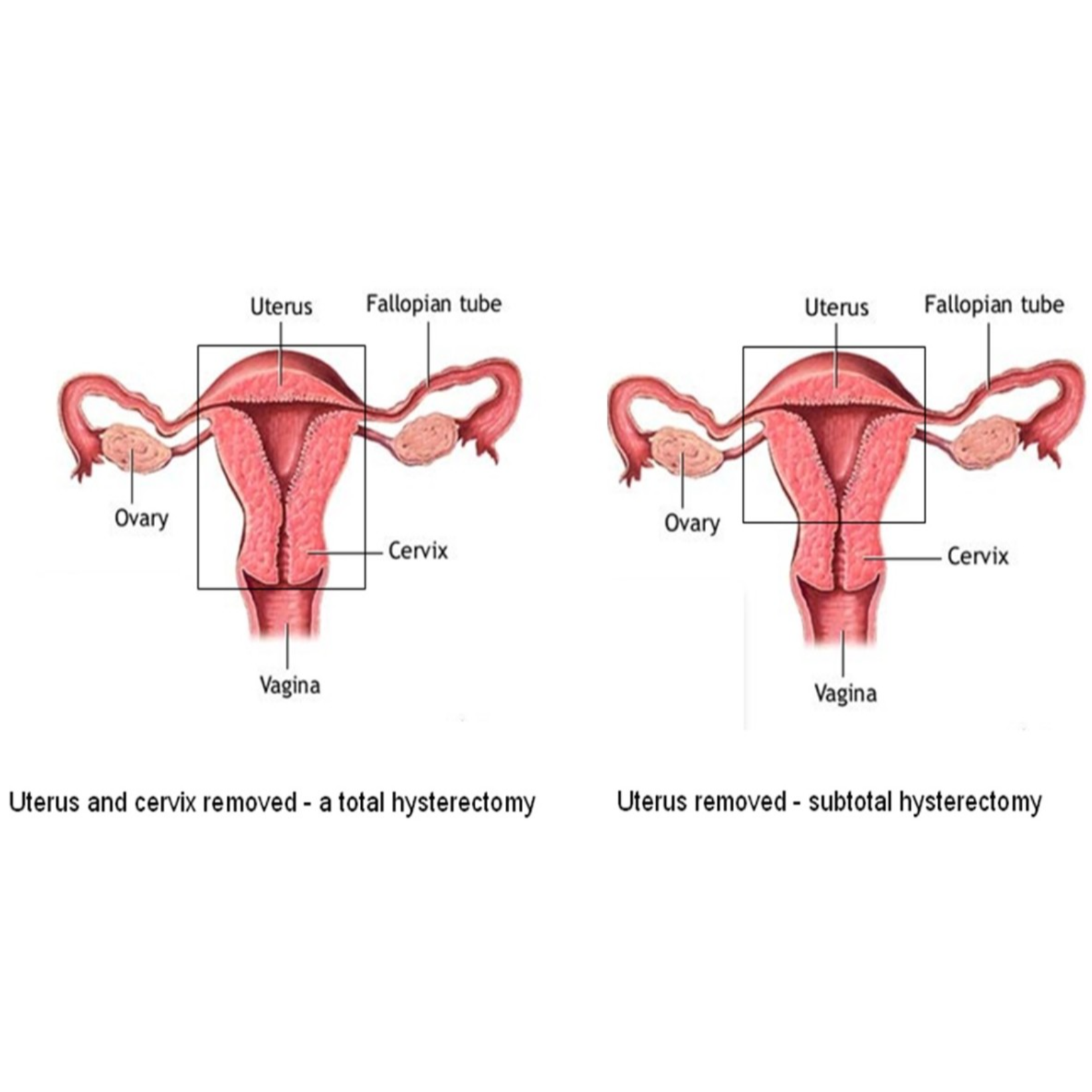 Best Hysterectomy Surgery in Nagpur - Advanced ... main image