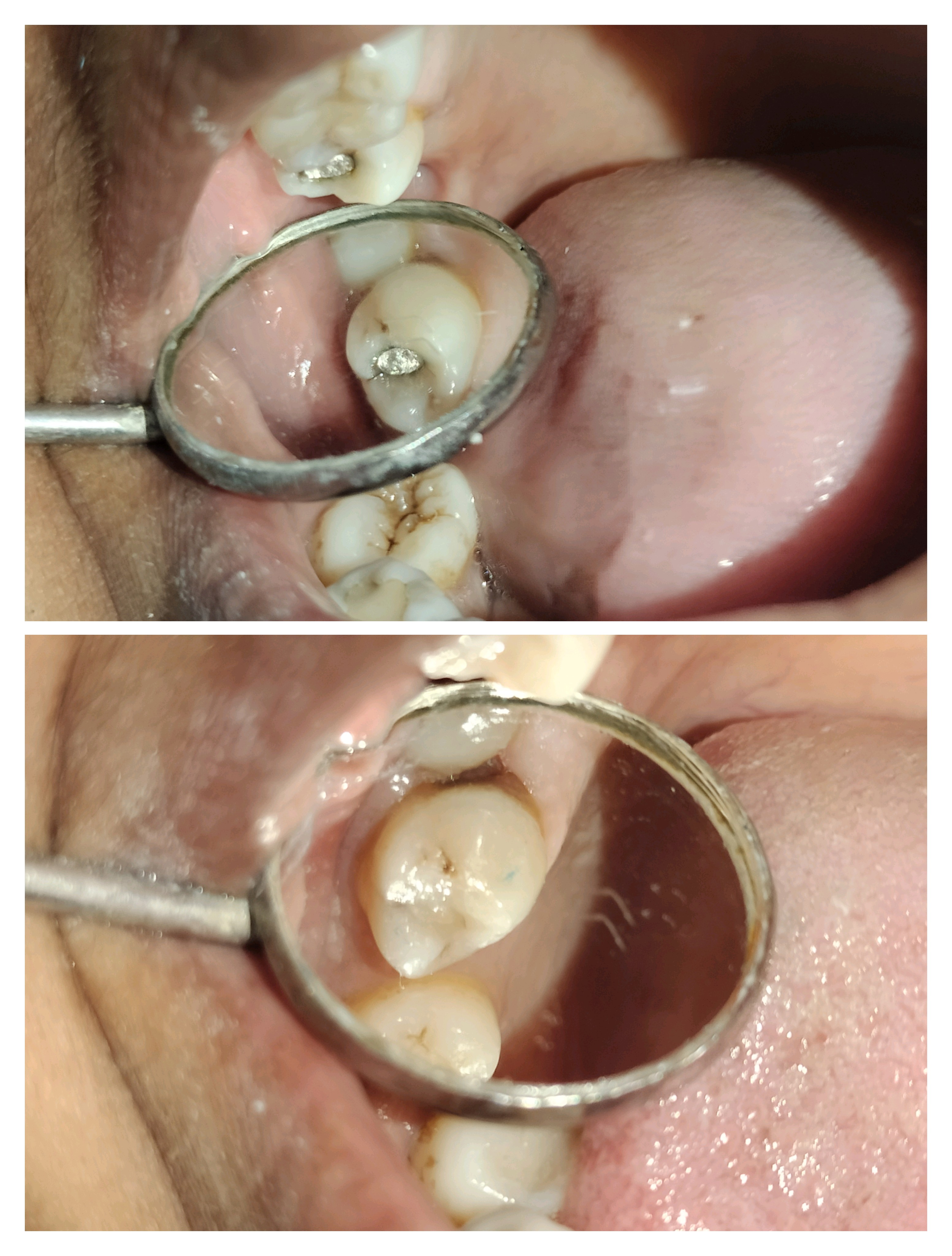 Best dentist to replace old fillings in Mira Ro... main image