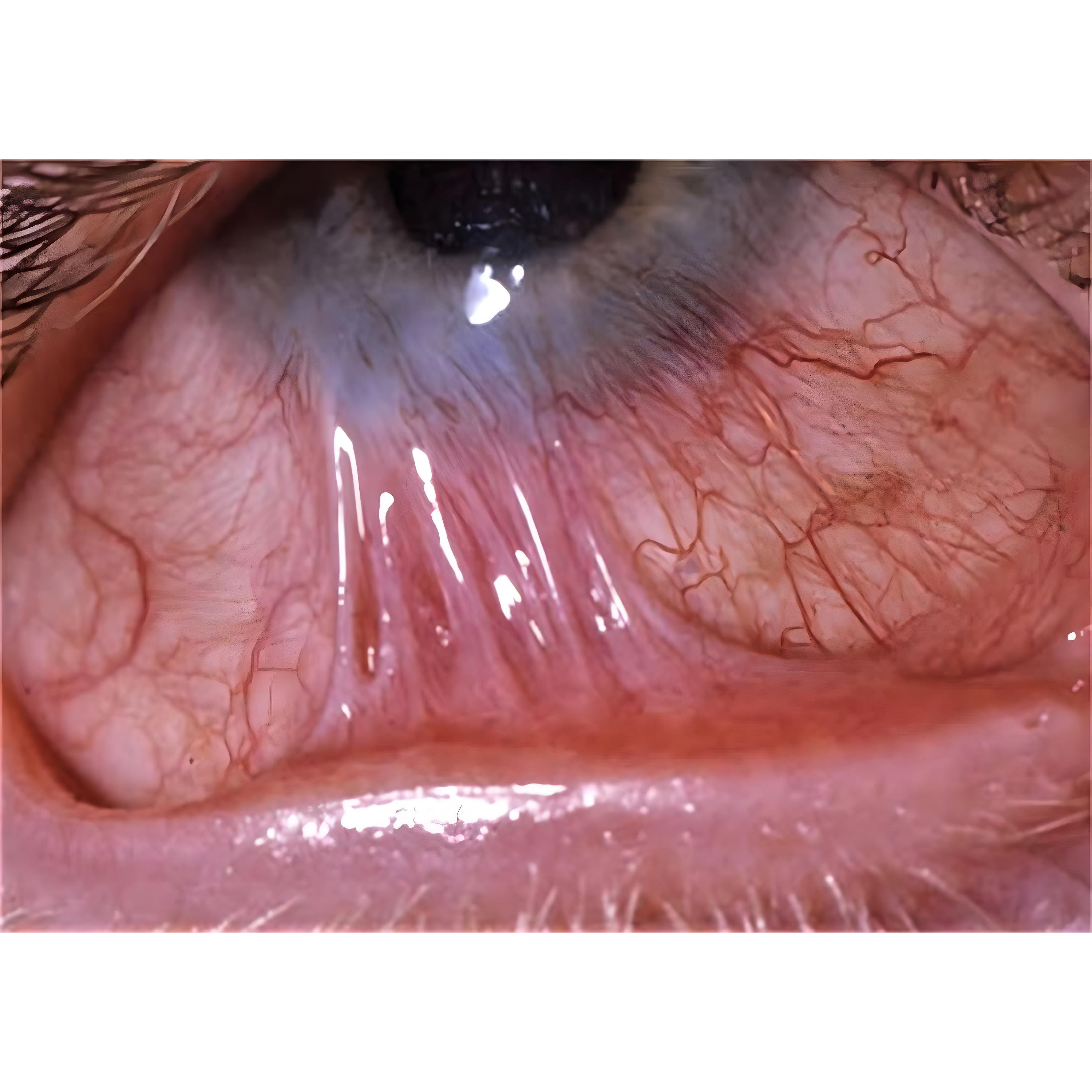 Symblepharon Management in Nagpur – Restoring E... main image