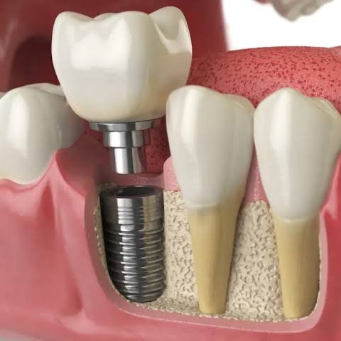 Affordable dental Implants in Mira Road Replace... main image