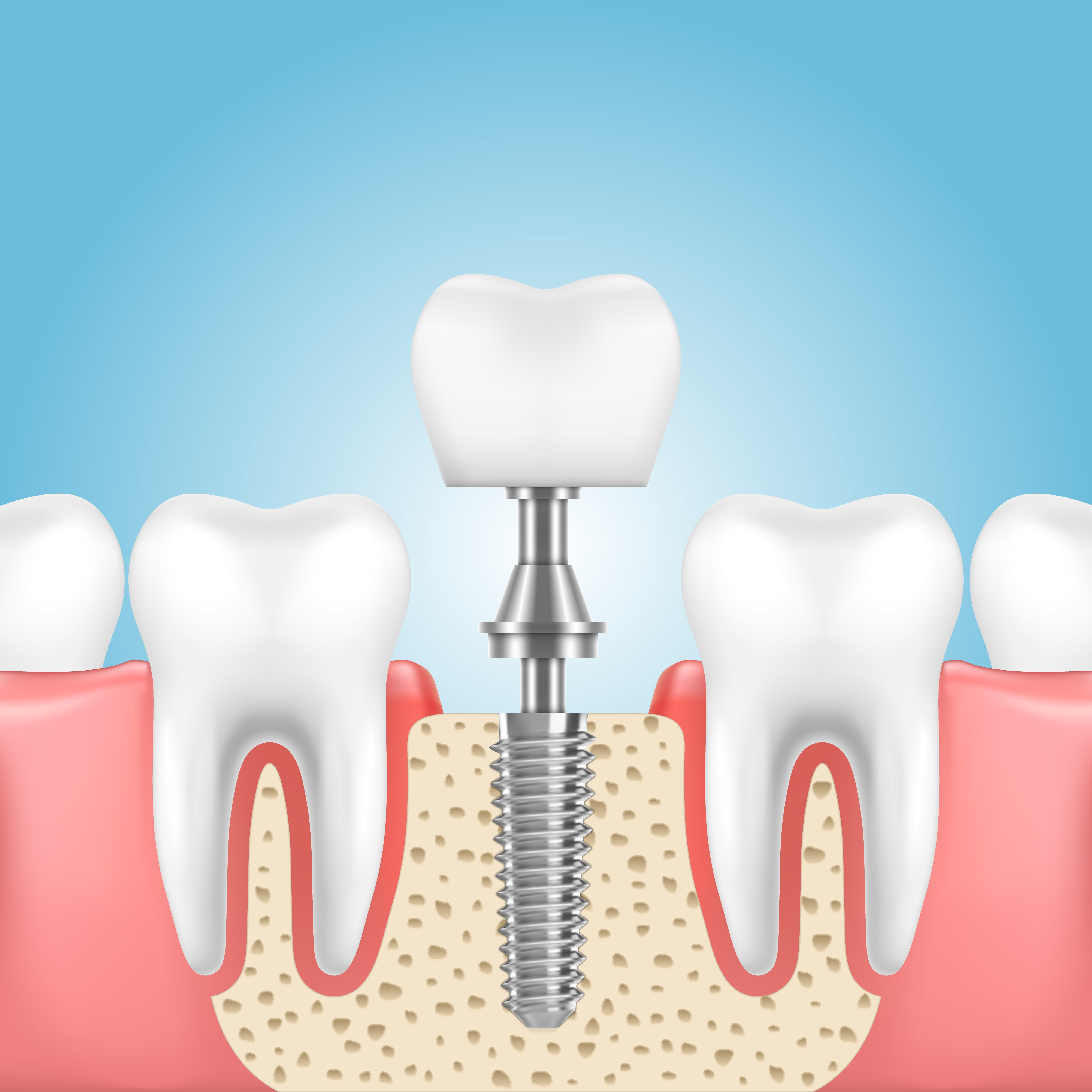 Dental Implant Treatment in Nagpur – Permanent ... main image