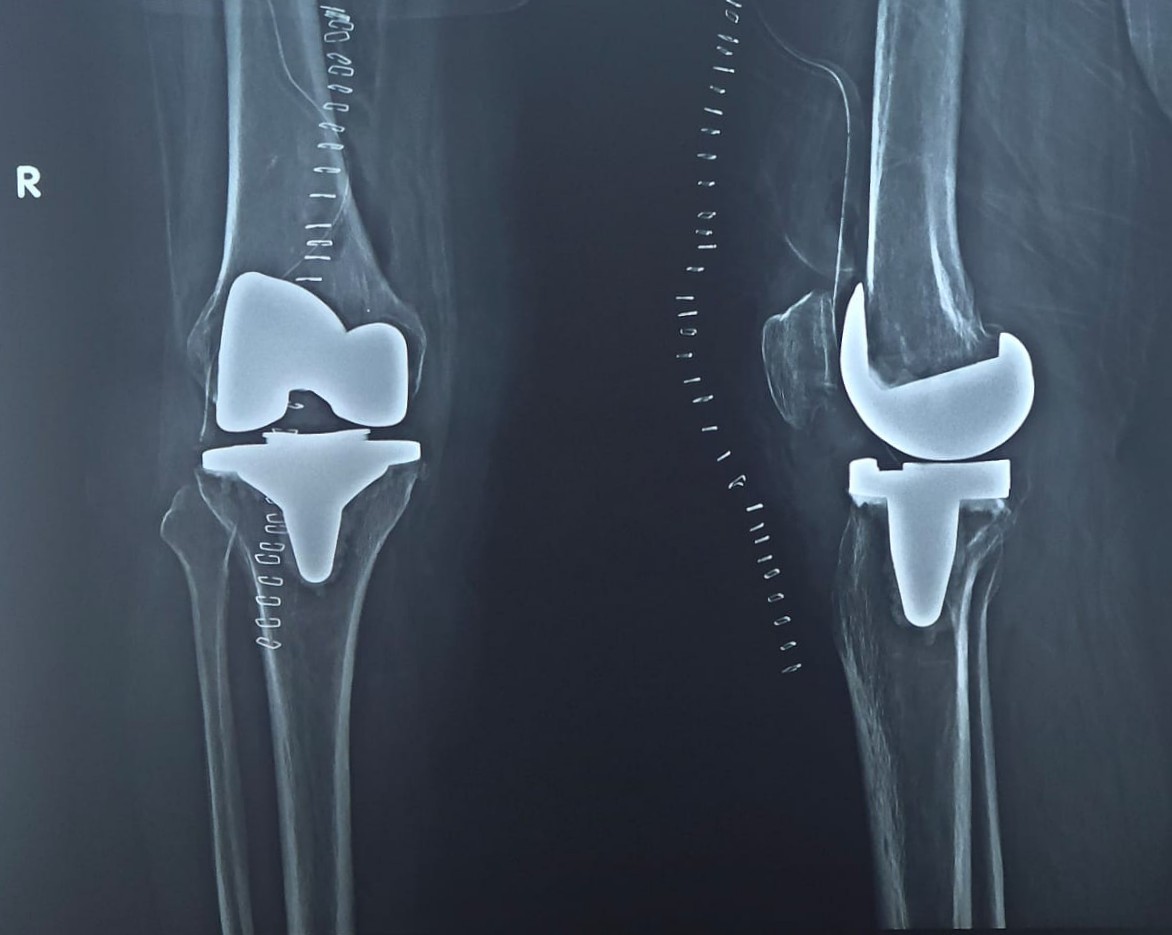 Knee replacement surgery .. : A surgery where the ... main image