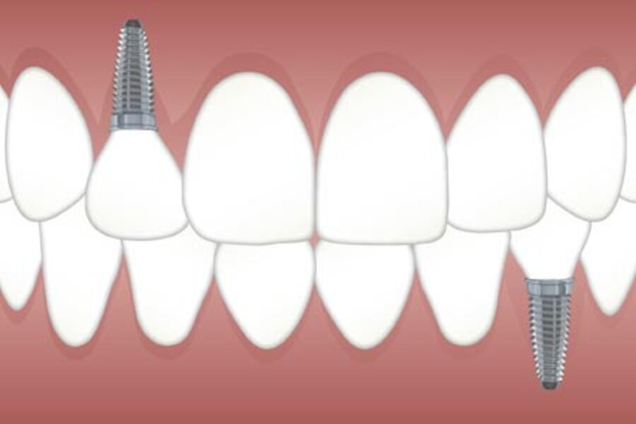 Dental Implants in Nashik for a Permanent Solution... main image