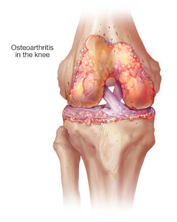Osteoarthritis of the knee, also known as degenera... main image
