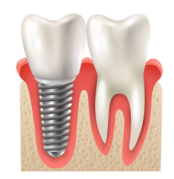 Dental Implants in Delhi – A Reliable Solution ... main image