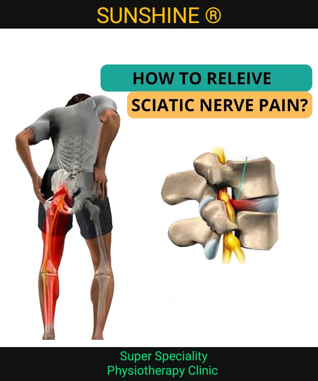 SCIATICA PAIN, EXERCISE, CAUSES, SYMPTOMS SCIATICA... main image