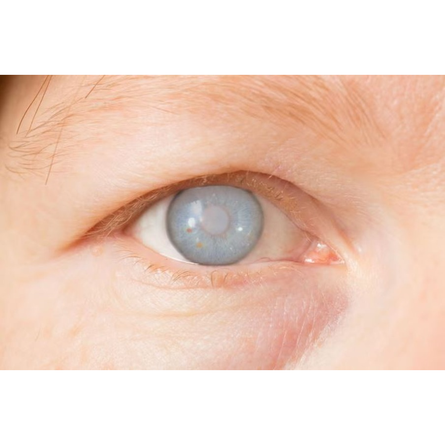 Cataract Solutions in Nagpur – Restore Clarity ... main image