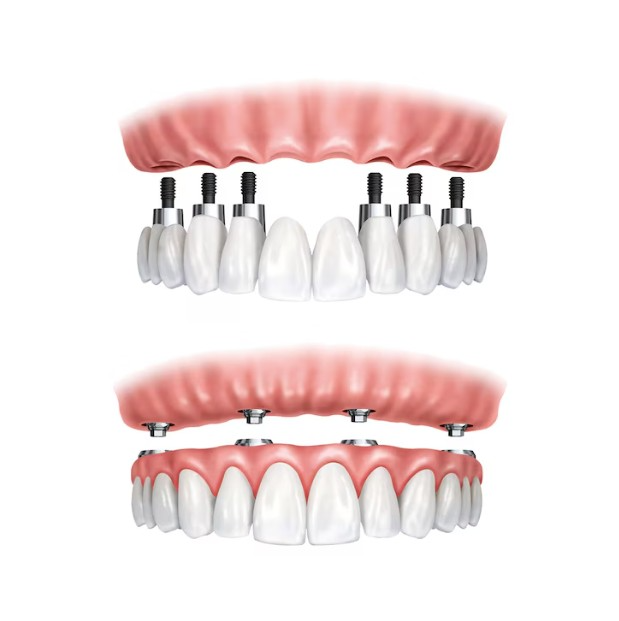 Full Mouth Implants in Delhi – Restore Your Smi... main image