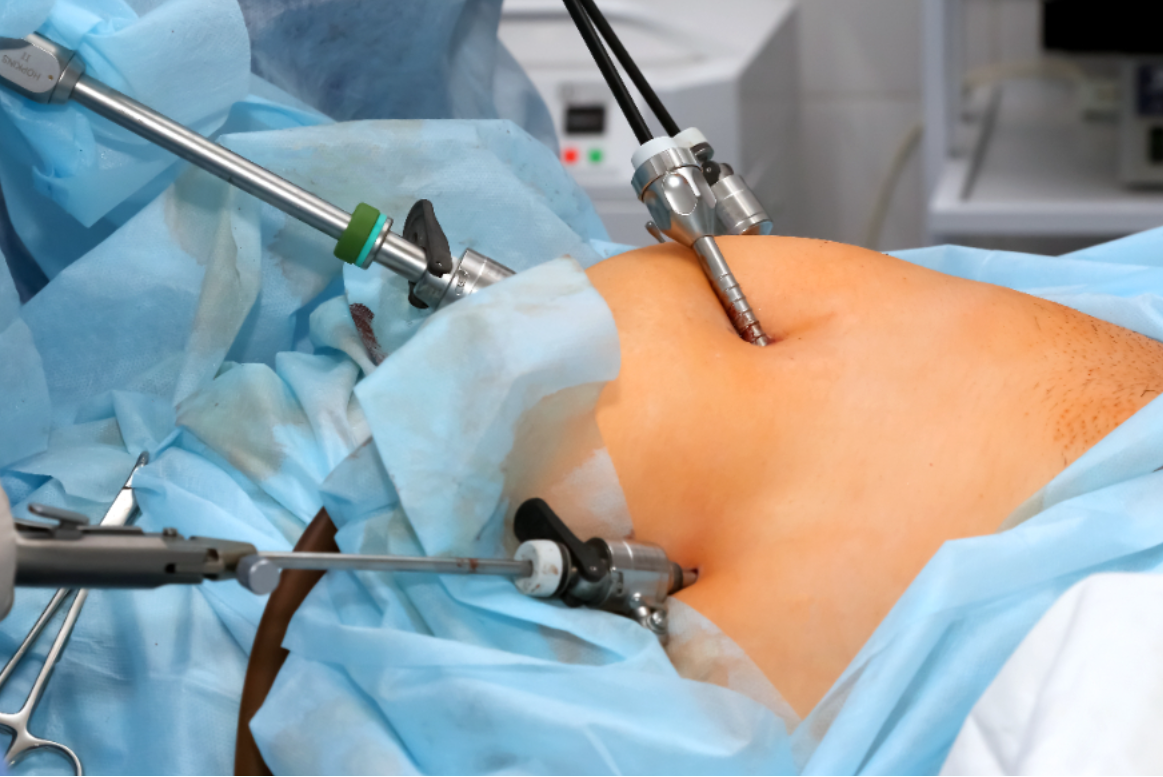 Best Laparoscopic Hernia Surgery in Pimpri – Ayush... main image