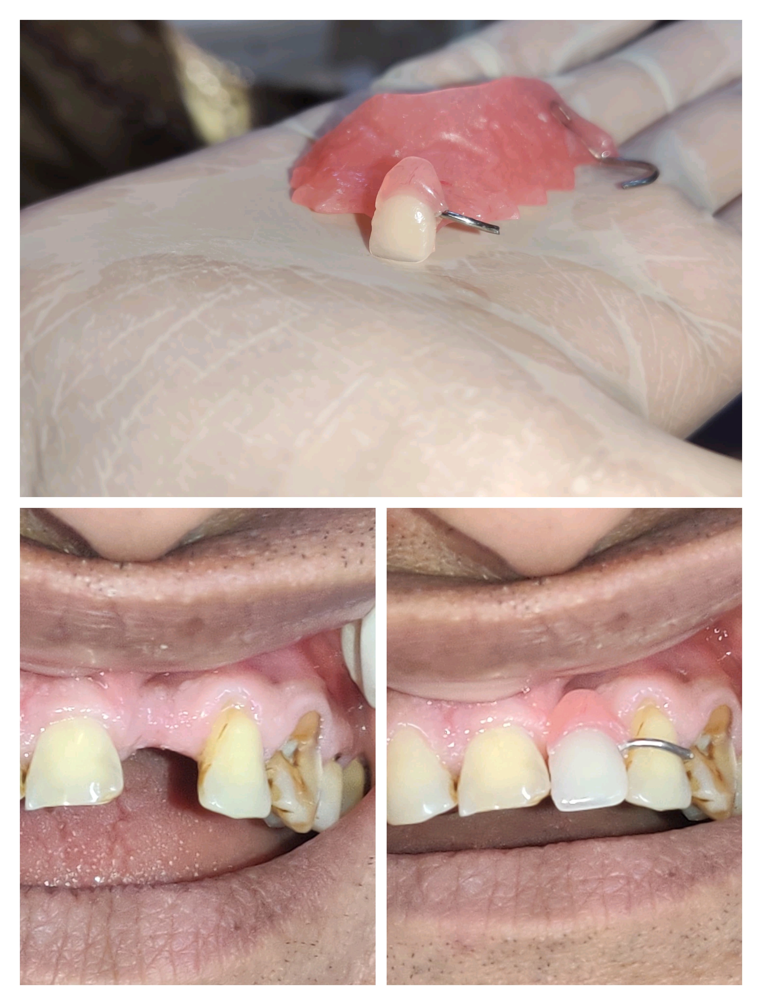 Denture doctor in Mira road Single tooth dentur... main image
