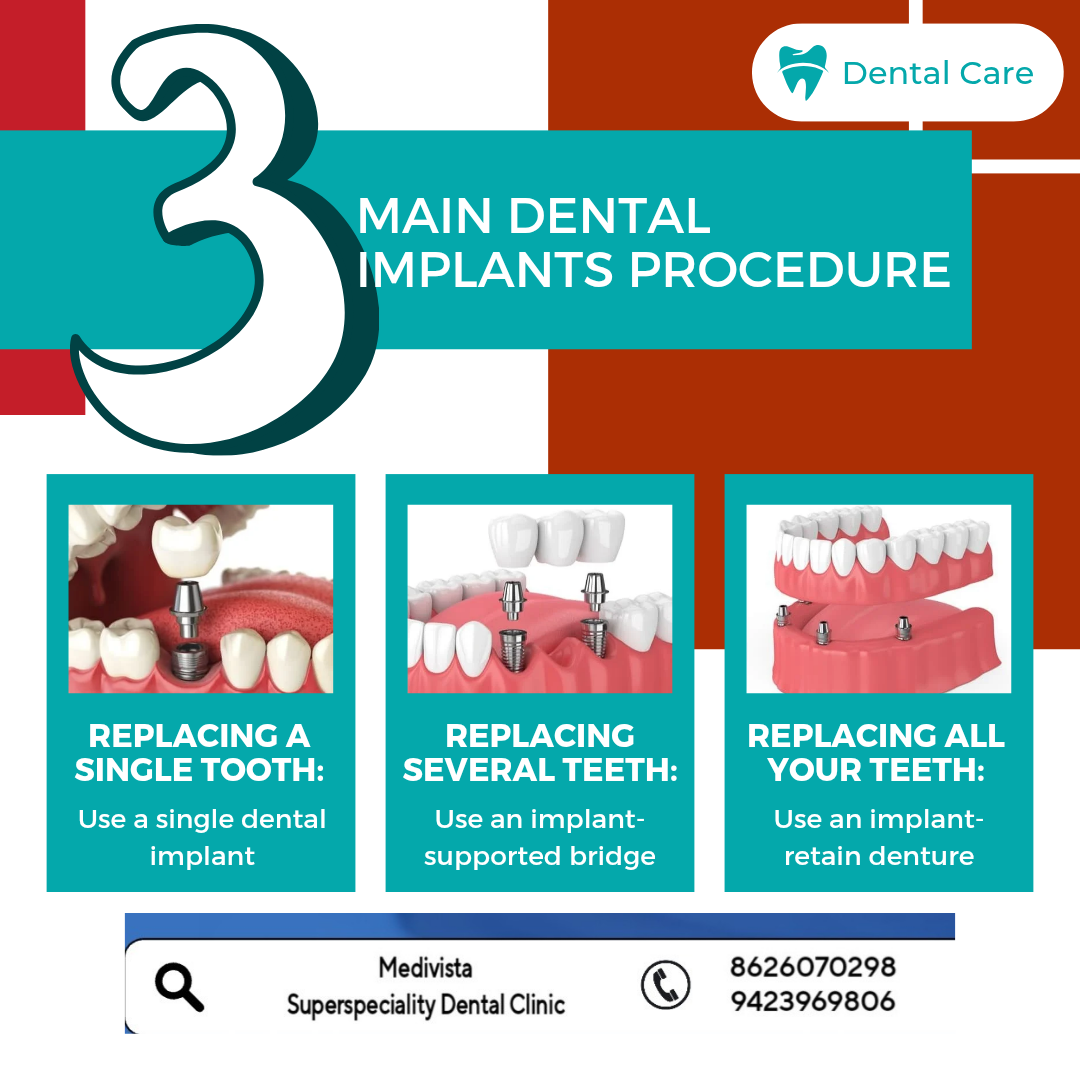 Missing Teeth? Dental Implants Have You heard o... main image
