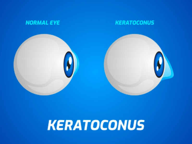 Keratoconus Treatment in Nagpur – Strengthening... main image
