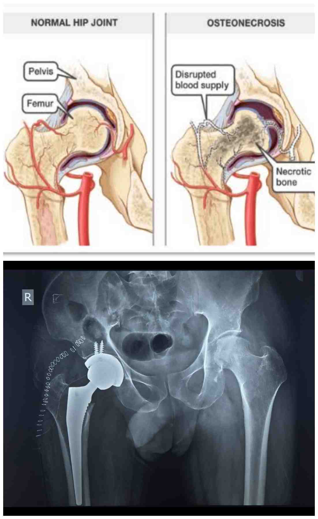 Avascular necrosis (AVN) of the hip, also known... main image
