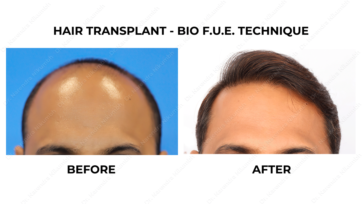 Hair Transplant Surgery in Thane
Hair Transplan... main image