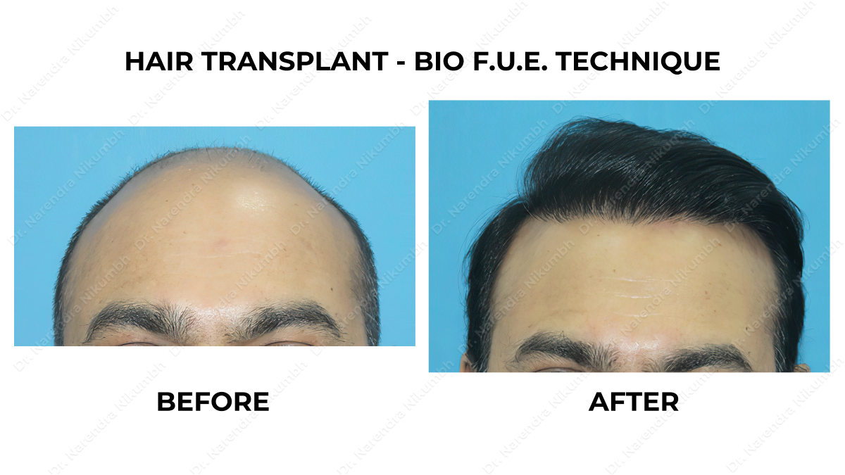 Safe Transplant Surgery in Thane
Natural Hair L... main image