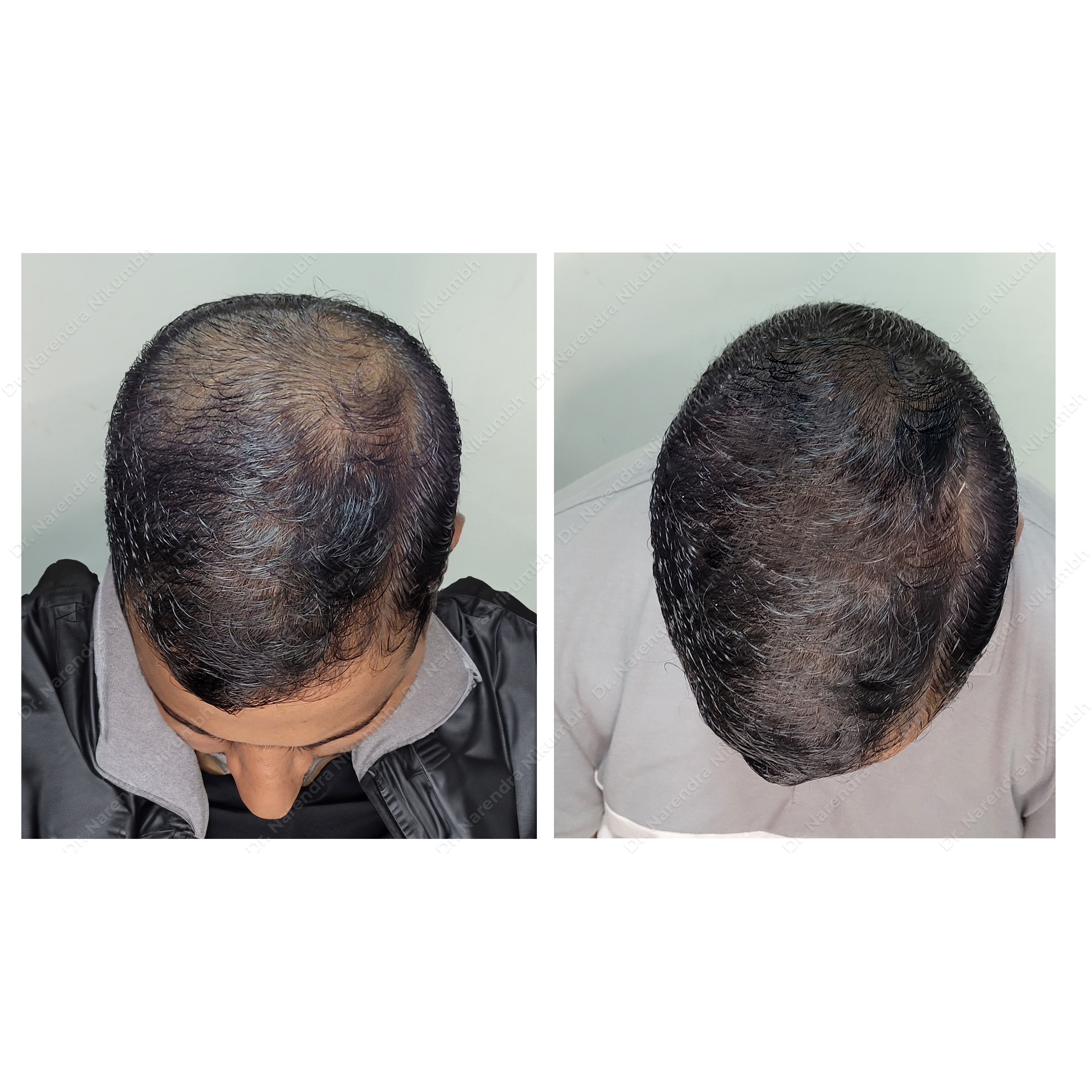Best Hair Loss Treatment in Thane Is provided a... main image
