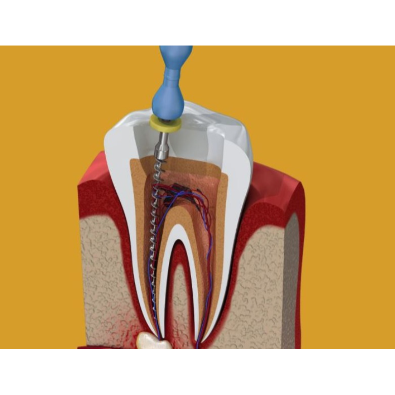 Root Canal Specialist in Nagpur – Save Your Nat... main image