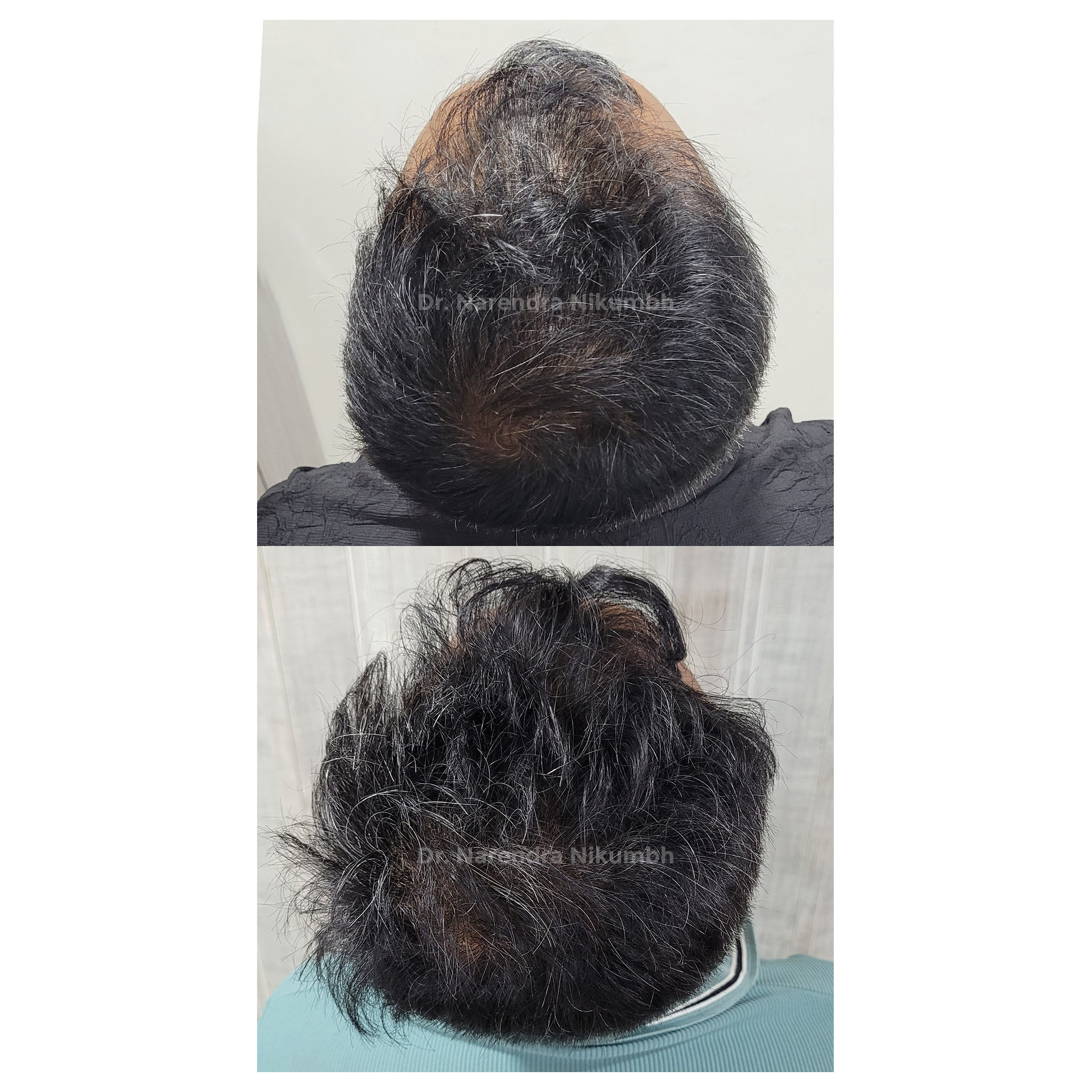 PRP vs GFC Treatment at Infinity Aesthetics Cli... main image