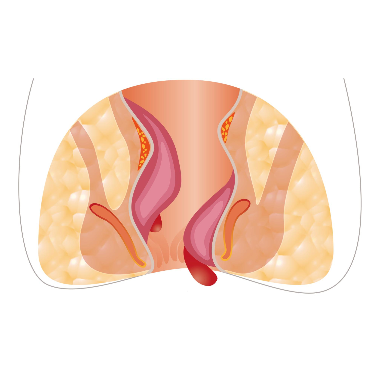 Fistula Treatment in Velachery, Chennai – Safe,... main image