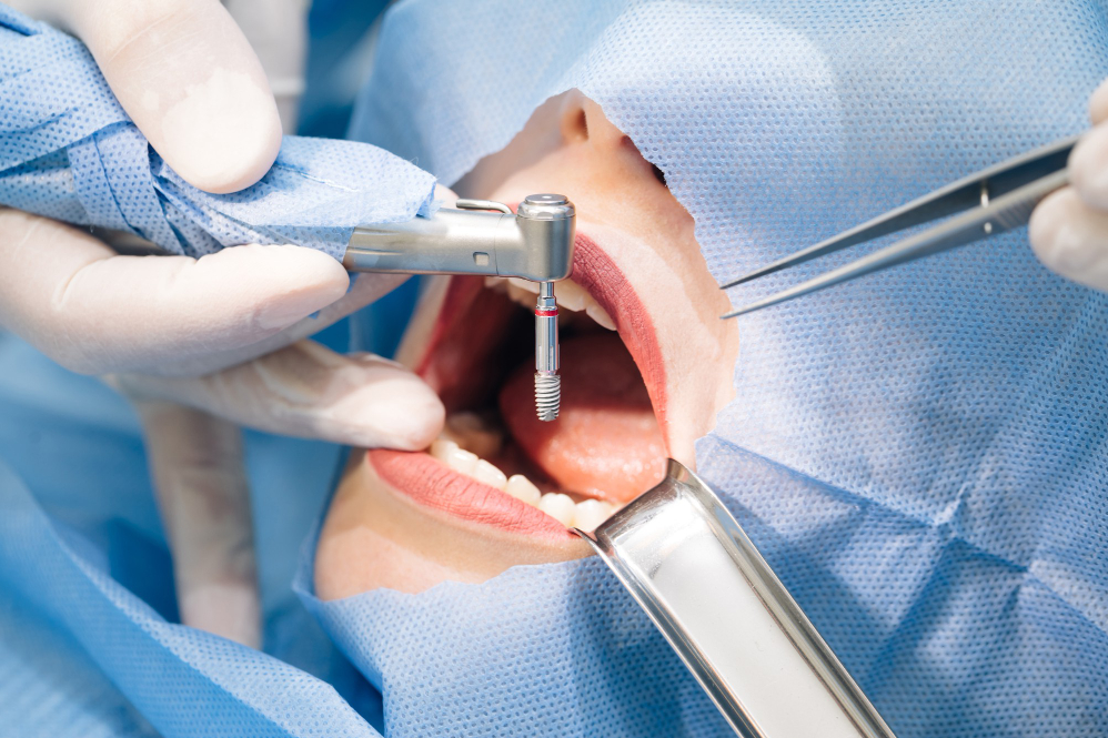 Surgical Tooth Removal Treatment in Delhi – Saf... main image