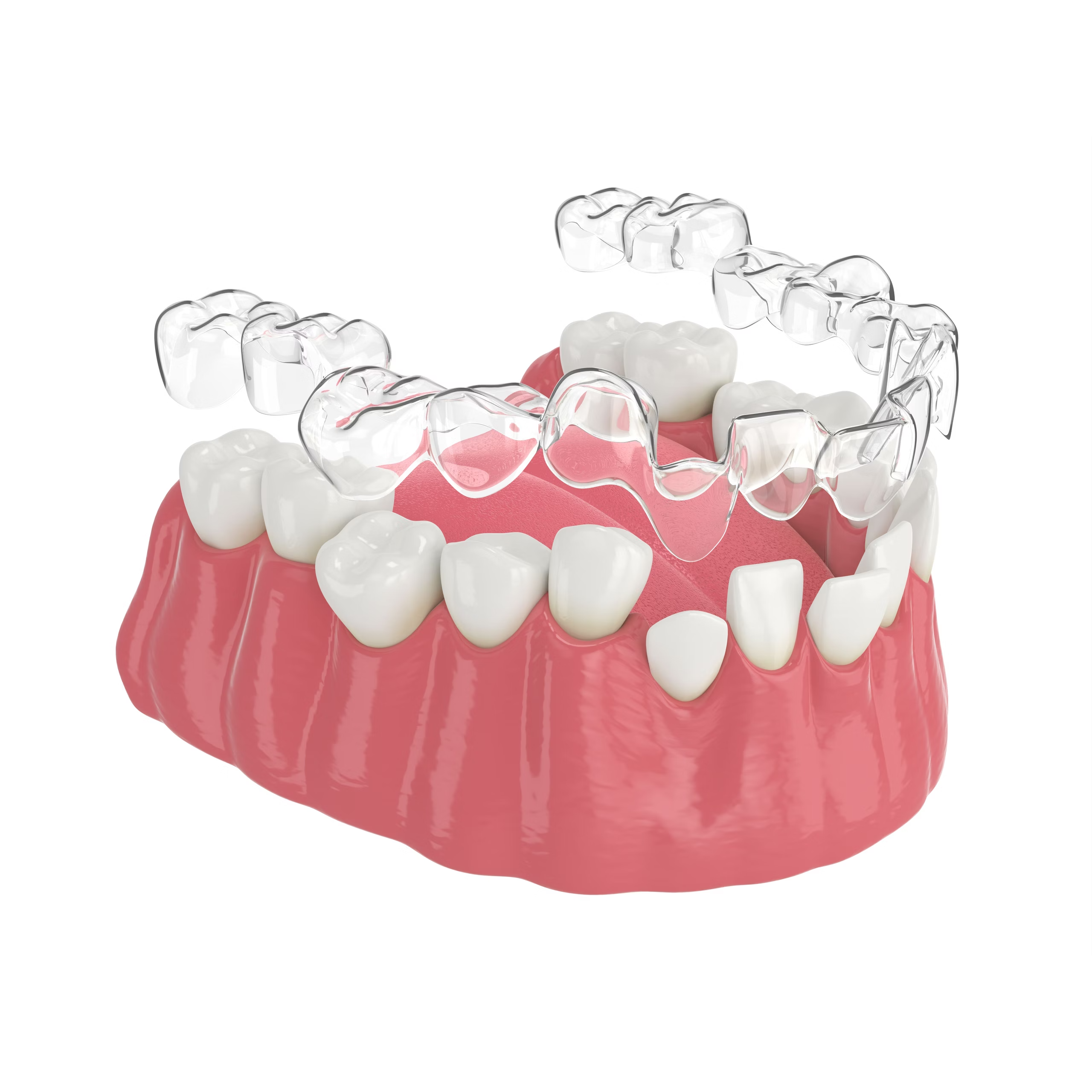 Clear Aligners in Jaipur – Smile Confidently wi... main image