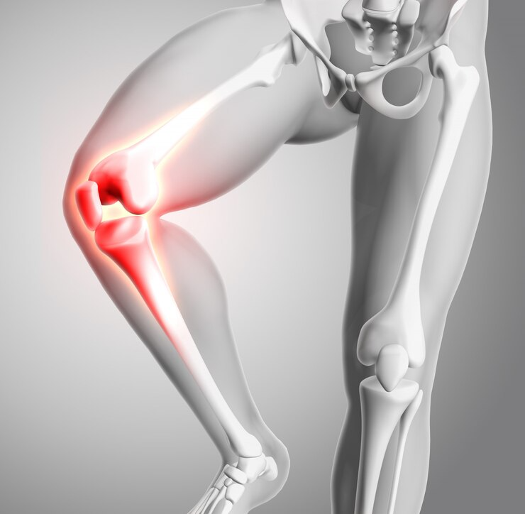 Joint Replacement in New Delhi – Advanced Care ... main image