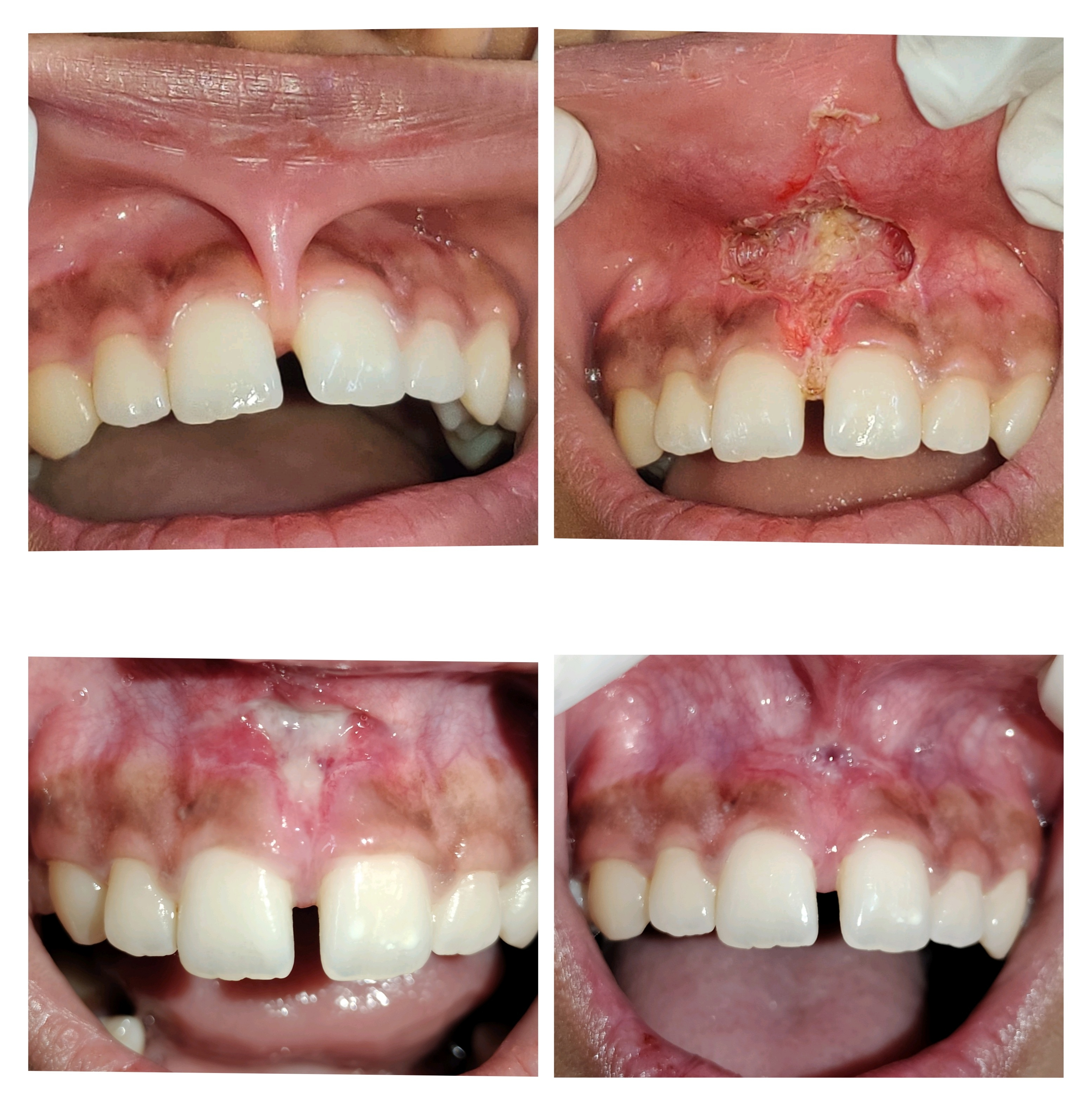 Laser dentist in Mira road Removal of frenum by... main image