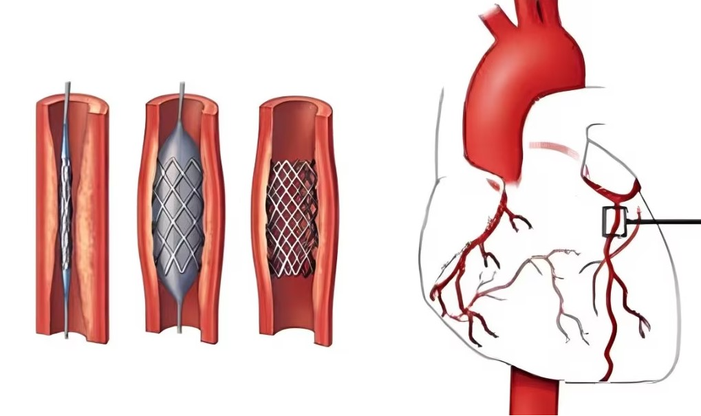 Completion Angiography in Nagpur Completion Ang... main image
