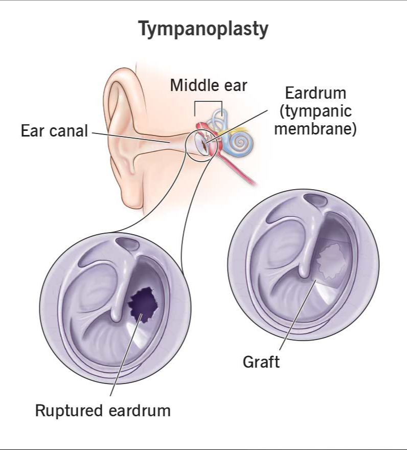 Tympanoplasty Surgery for Ear Hole in Dwarka, Delh... main image