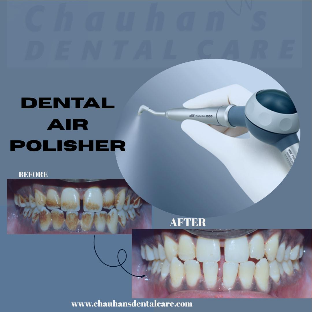 Air polishing is a gentle yet powerful way to brig... main image